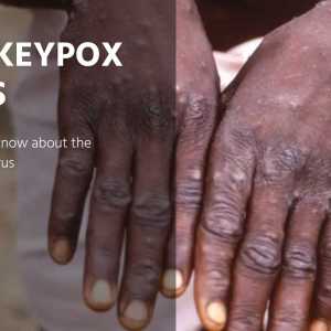 Monkeypox Virus - Key Points To Know