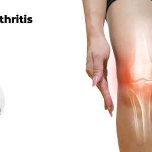 Osteoarthritis
