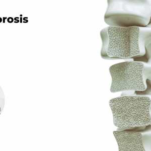 Osteoporosis